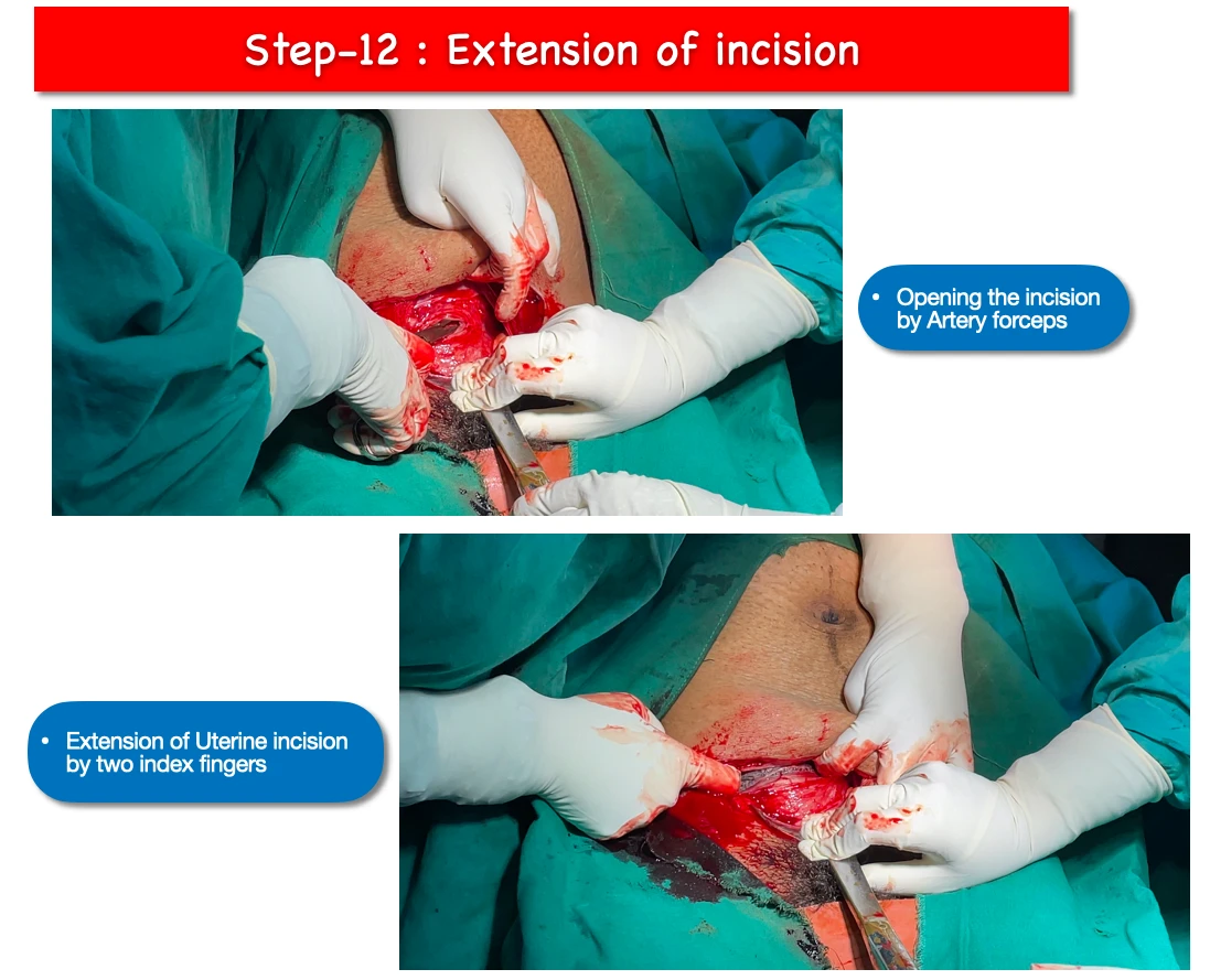 LSCS step 12